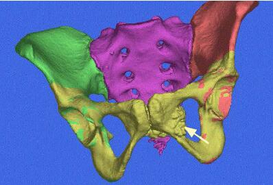 Simulation Makes Personalized Healthcare And 3d Printed Implants 